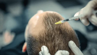 علاج تساقط الشعر باستخدام السائل المنوي