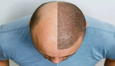 عاجل: ثورة الروبوتات السعودية تقضي على الصلع نهائياً – نجاح 95% وشفاء في 3 أيام فقط!