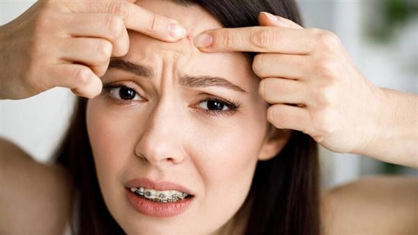 للنشر 8 ص.. وصفات طبيعية سريعة المفعول لعلاج حبوب الجبهة الصيفية