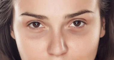 أطباء يكشفون الأسباب الحقيقية للهالات السوداء وطرق التخلص منها