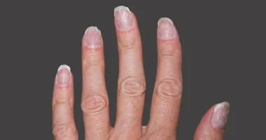 علامات صامتة على أظافرك قد تكشف أمراضًا كامنة.. متى يجب زيارة الطبيب؟