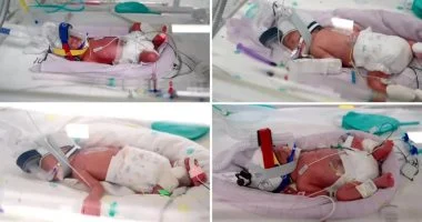 حالة نادرة للغاية.. أسترالية تنجب 4 توائم متطابقين بمشيمة واحدة