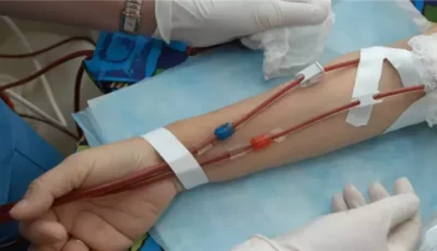 أسباب آلام العظام عند مرضى الغسيل الكلوي وطرق التعامل معها