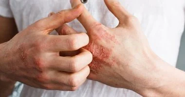 الأكزيما أم الصدفية؟ أهم الفروق بين المرضين وأسباب ظهور كل منهما