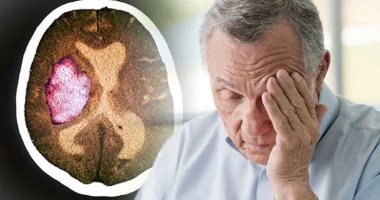 السكتة الدماغية الصباحية.. لماذا تحدث بين السادسة وفترة الظهيرة؟