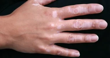 حبة واحدة يوميا.. الإمارات تعتمد استخدام دواء عن طريق الفم لعلاج البهاق
