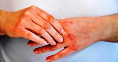 5 عادات صيفية قد تسبب تهيج الصدفية.. تجنبها لحماية بشرتك
