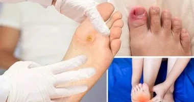 8 أسباب لآلام القدم.. متى تكون ناتجة عن الإجهاد