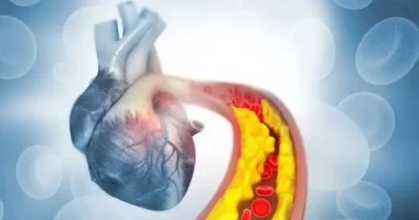أطباء قلب يحذرون.. 3 أخطاء يجب التوقف عنها عند ارتفاع الكوليسترول