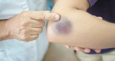كدمة أم ورم دموي؟.. اعرف الفرق وأسباب ظهور البقع الزرقاء ومتى تحتاج للطبيب