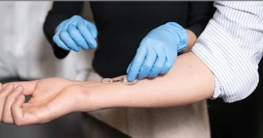 فقاعات الحروق.. خطوات علاجها فى المنزل وأخطاء يجب تجنبها لتسريع الشفاء