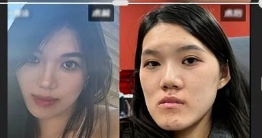 تصحيح بروز 2 مم في الفك يتحول إلى تشوه كبير بوجه شابة صينية