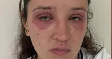 حساسية شديدة بسبب الرموش الصناعية.. عروس بريطانية تروى تجربتها