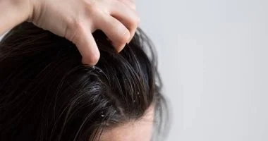 وصفات طبيعية لعلاج مشكلة قشرة الرأس.. خطواتها بسيطة وآمنة
