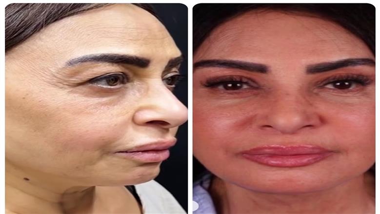 سلوى خطاب تفاجئ الجمهور بأحدث ظهور بعد إجراء عملية تجميل