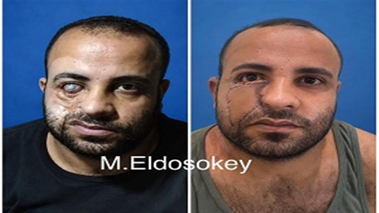 رصاصة خرطوش أبقت عينه مفتوحة 14 عاما.. جراحة مصرية تعيد الأمل لشاب من الصعيد