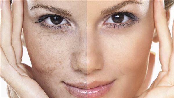 ماسكات طبيعية تساعد على تقليل تصبغات البشرة واستعادة صفائها