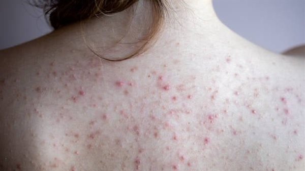اصنعى بنفسك صابونة طبيعية لعلاج حبوب الظهر